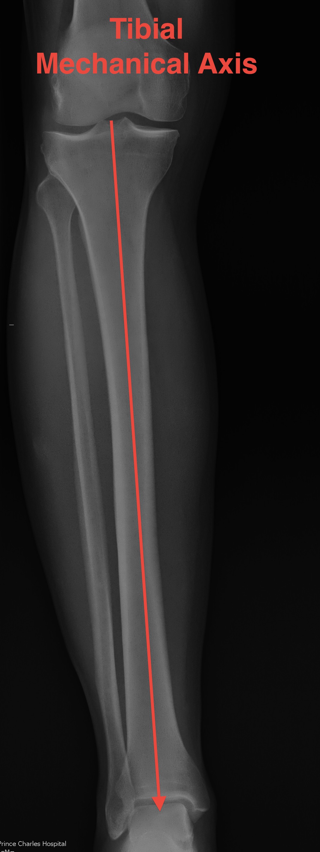 Mechanical Axis Tibia